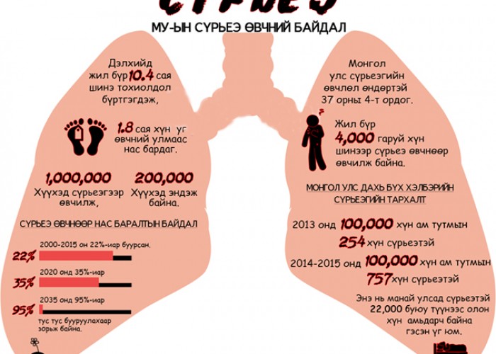2024 онд сүрьеэ өвчнөөр 415 хүн нас барсан байна