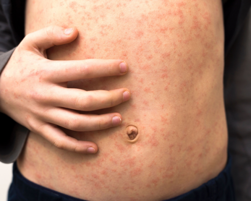 Улаанбурхан өвчний нийт батлагдсан тохиолдол 13.541 хүрлээ