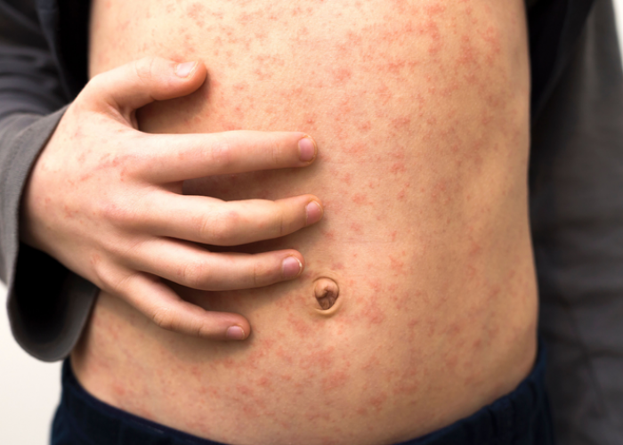 Улаанбурхан өвчний нийт батлагдсан тохиолдол 13.541 хүрлээ