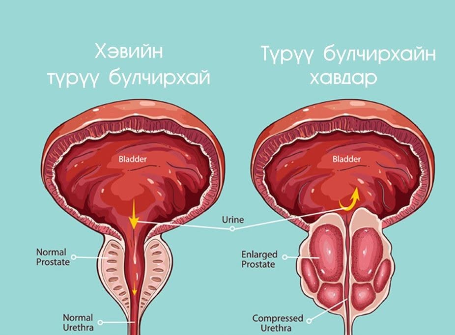 Англи Улсад түрүү булчирхайн хорт хавдрын шинэ эмчилгээ хийж эхэлжээ