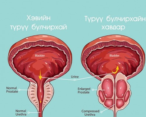 Англи Улсад түрүү булчирхайн хорт хавдрын шинэ эмчилгээ хийж эхэлжээ