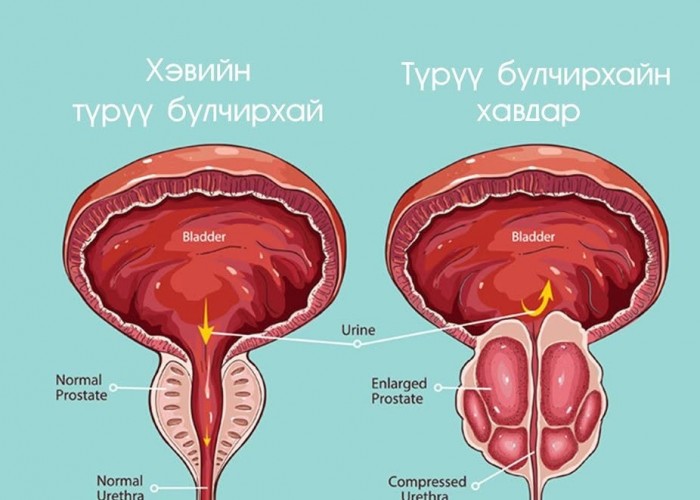 Англи Улсад түрүү булчирхайн хорт хавдрын шинэ эмчилгээ хийж эхэлжээ